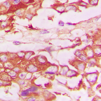 TNFRSF1B / TNFR2 Antibody - Immunohistochemical analysis of CD120b staining in human lung cancer formalin fixed paraffin embedded tissue section. The section was pre-treated using heat mediated antigen retrieval with sodium citrate buffer (pH 6.0). The section was then incubated with the antibody at room temperature and detected using an HRP conjugated compact polymer system. DAB was used as the chromogen. The section was then counterstained with hematoxylin and mounted with DPX.