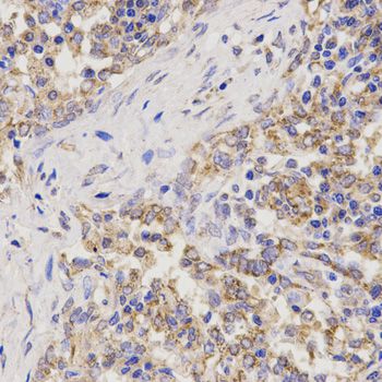 TNFRSF1B / TNFR2 Antibody - Immunohistochemistry of paraffin-embedded human lung cancer using TNFRSF1B antibody at dilution of 1:200 (40x lens).