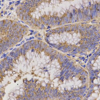 TNFRSF1B / TNFR2 Antibody - Immunohistochemistry of paraffin-embedded human rectal cancer using TNFRSF1B antibody at dilution of 1:200 (40x lens).