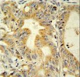 TNFRSF6B / DCR3 Antibody - TNFRSF6B antibody immunohistochemistry of formalin-fixed and paraffin-embedded human colon carcinoma followed by peroxidase-conjugated secondary antibody and DAB staining.