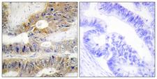 TNFRSF6B / DCR3 Antibody - Immunohistochemistry analysis of paraffin-embedded human colon carcinoma tissue, using TNFRSF6B Antibody. The picture on the right is blocked with the synthesized peptide.