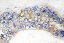 TNFRSF6B / DCR3 Antibody - IHC of DcR3 (G287) pAb in paraffin-embedded human colon carcinoma tissue.
