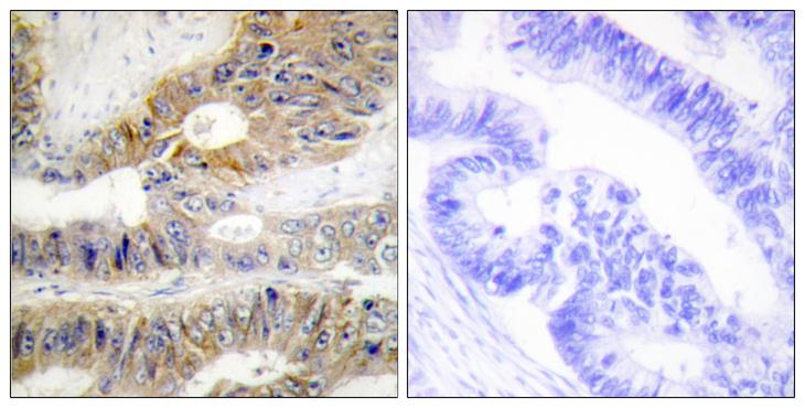 TNFRSF6B / DCR3 Antibody - Peptide - + Immunohistochemistry analysis of paraffin-embedded human colon carcinoma tissue using TNFRSF6B antibody.