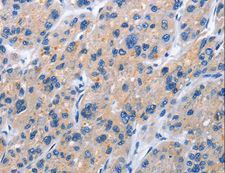 TNFRSF9 / 4-1BB / CD137 Antibody - Immunohistochemistry of paraffin-embedded Human gastric cancer using TNFRSF9 Polyclonal Antibody at dilution of 1:40.