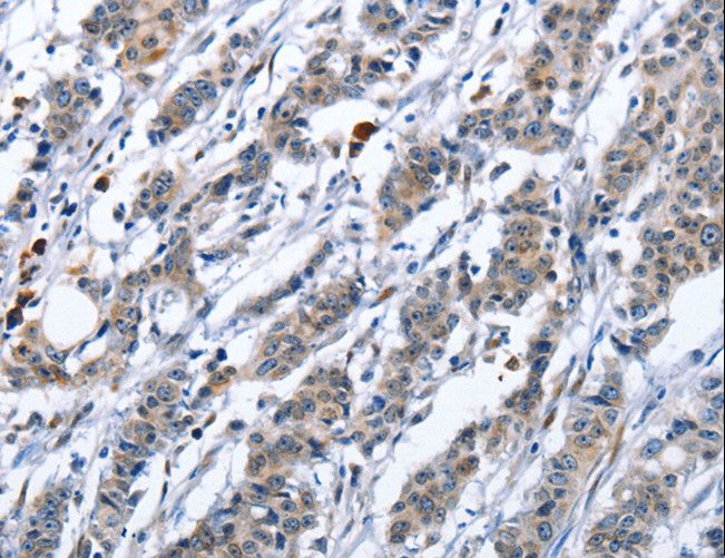 TNFRSF9 / 4-1BB / CD137 Antibody - Immunohistochemistry of paraffin-embedded Human gastric cancer using TNFRSF9 Polyclonal Antibody at dilution of 1:40.
