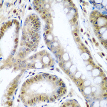 TNFSF10 / TRAIL Antibody - Immunohistochemistry of paraffin-embedded human colon carcinoma tissue.