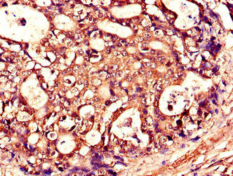 TNFSF11 / RANKL / TRANCE Antibody - Immunohistochemistry of paraffin-embedded human gastric cancer using TNFSF11 Antibody at dilution of 1:100