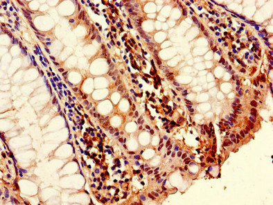 TNFSF11 / RANKL / TRANCE Antibody - Immunohistochemistry of paraffin-embedded human colon cancer using TNFSF11 Antibody at dilution of 1:100
