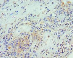 TNFSF13 / APRIL Antibody - Immunohistochemistry of paraffin-embedded human breast cancer using antibody at 1:100 dilution.