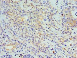TNFSF13 / APRIL Antibody - Immunohistochemistry of paraffin-embedded human breast cancer using antibody at 1:100 dilution.
