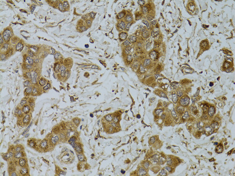 TNFSF13 / APRIL Antibody - Immunohistochemistry of paraffin-embedded human liver cancer using TNFSF13 antibodyat dilution of 1:100 (40x lens).