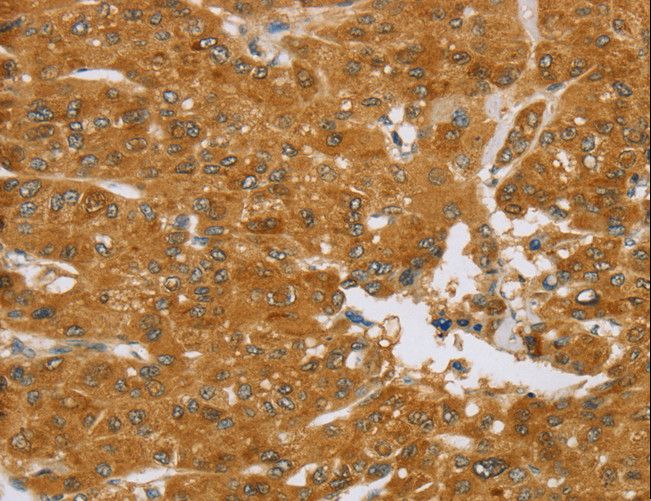 TNFSF13 / APRIL Antibody - Immunohistochemistry of paraffin-embedded Human liver cancer using TNFSF13 Polyclonal Antibody at dilution of 1:40.