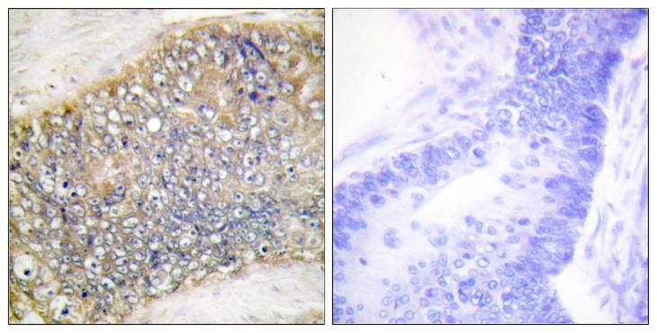 TNFSF13 / APRIL Antibody - Peptide - + Immunohistochemistry analysis of paraffin-embedded human colon carcinoma tissue using TALL-2 antibody.