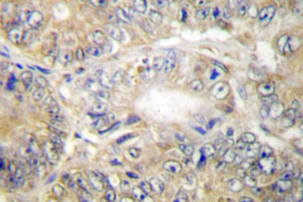 TNFSF13 / APRIL Antibody - IHC of APRIL (S183) pAb in paraffin-embedded human colon carcinoma tissue.