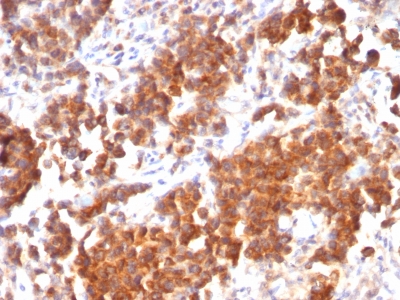 TNFSF15 / TL1A / VEGI Antibody - Formalin-fixed, paraffin-embedded human Parathyroid Mass stained with TNFS15 / VEGI Monoclonal Antibody (rVEGI /1283).