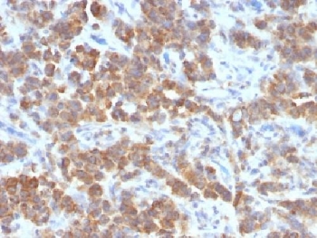 TNFSF15 / TL1A / VEGI Antibody - IHC testing of FFPE human parathyroid mass with TL1A antibody (clone VEGI/1283). Required HIER: boil sections in 10mM Tris with 1mM EDTA, pH9, for 10-20 min followed by cooling at RT for 20 min.