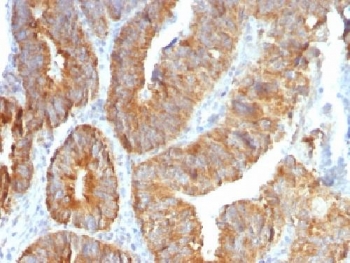 TNFSF15 / TL1A / VEGI Antibody - IHC testing of FFPE human colon carcinoma with TL1A antibody (clone VEGI/1283). Required HIER: boil sections in 10mM Tris with 1mM EDTA, pH9, for 10-20 min followed by cooling at RT for 20 min.