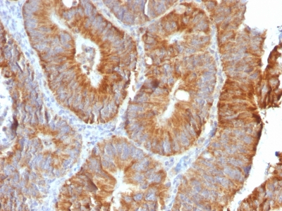 TNFSF15 / TL1A / VEGI Antibody - Formalin-fixed, paraffin-embedded human Colon Carcinoma stained with VEGI Rabbit Recombinant Monoclonal Antibody (VEGI /2052R).