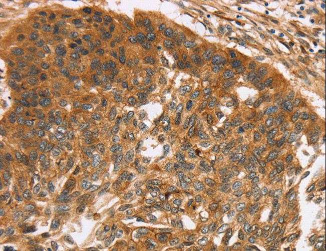 TNFSF15 / TL1A / VEGI Antibody - Immunohistochemistry of paraffin-embedded Human esophagus cancer using TNFSF15 Polyclonal Antibody at dilution of 1:40.