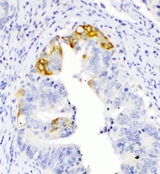 TNFSF15 / TL1A / VEGI Antibody - IHC analysis of TL1A using anti-TL1A antibody. TL1A was detected in paraffin-embedded section of human intestinal cancer tissues. Heat mediated antigen retrieval was performed in citrate buffer (pH6, epitope retrieval solution) for 20 mins. The tissue section was blocked with 10% goat serum. The tissue section was then incubated with 1µg/ml rabbit anti-TL1A Antibody overnight at 4°C. Biotinylated goat anti-rabbit IgG was used as secondary antibody and incubated for 30 minutes at 37°C. The tissue section was developed using Strepavidin-Biotin-Complex (SABC) with DAB as the chromogen.