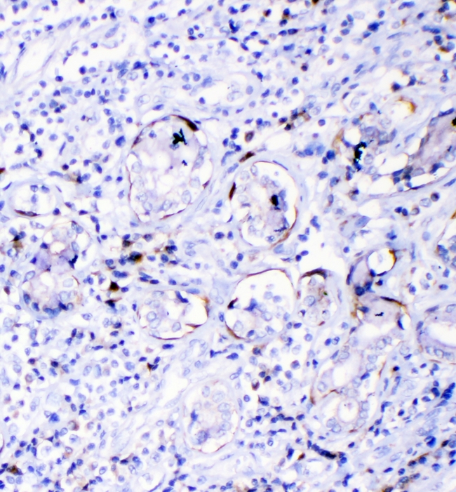 TNFSF15 / TL1A / VEGI Antibody - IHC analysis of TL1A using anti-TL1A antibody. TL1A was detected in paraffin-embedded section of human lung cancer tissues. Heat mediated antigen retrieval was performed in citrate buffer (pH6, epitope retrieval solution) for 20 mins. The tissue section was blocked with 10% goat serum. The tissue section was then incubated with 1µg/ml rabbit anti-TL1A Antibody overnight at 4°C. Biotinylated goat anti-rabbit IgG was used as secondary antibody and incubated for 30 minutes at 37°C. The tissue section was developed using Strepavidin-Biotin-Complex (SABC) with DAB as the chromogen.