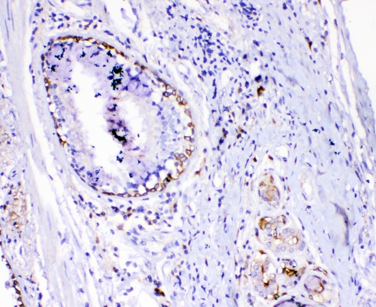 TNFSF15 / TL1A / VEGI Antibody - IHC analysis of TL1A using anti-TL1A antibody. TL1A was detected in paraffin-embedded section of human lung cancer tissues. Heat mediated antigen retrieval was performed in citrate buffer (pH6, epitope retrieval solution) for 20 mins. The tissue section was blocked with 10% goat serum. The tissue section was then incubated with 1µg/ml rabbit anti-TL1A Antibody overnight at 4°C. Biotinylated goat anti-rabbit IgG was used as secondary antibody and incubated for 30 minutes at 37°C. The tissue section was developed using Strepavidin-Biotin-Complex (SABC) with DAB as the chromogen.