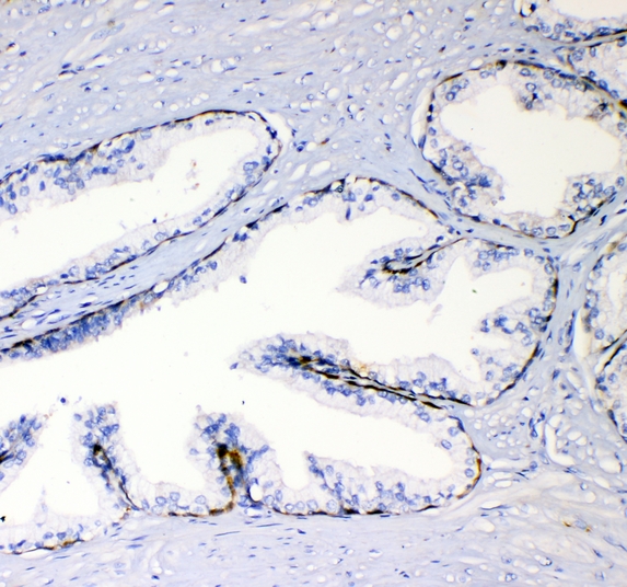 TNFSF15 / TL1A / VEGI Antibody - IHC analysis of TL1A using anti-TL1A antibody. TL1A was detected in paraffin-embedded section of human prostatic cancer tissues. Heat mediated antigen retrieval was performed in citrate buffer (pH6, epitope retrieval solution) for 20 mins. The tissue section was blocked with 10% goat serum. The tissue section was then incubated with 1µg/ml rabbit anti-TL1A Antibody overnight at 4°C. Biotinylated goat anti-rabbit IgG was used as secondary antibody and incubated for 30 minutes at 37°C. The tissue section was developed using Strepavidin-Biotin-Complex (SABC) with DAB as the chromogen.