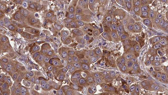 TNFSF18 / GITRL Antibody - 1:100 staining human liver carcinoma tissues by IHC-P. The sample was formaldehyde fixed and a heat mediated antigen retrieval step in citrate buffer was performed. The sample was then blocked and incubated with the antibody for 1.5 hours at 22°C. An HRP conjugated goat anti-rabbit antibody was used as the secondary.