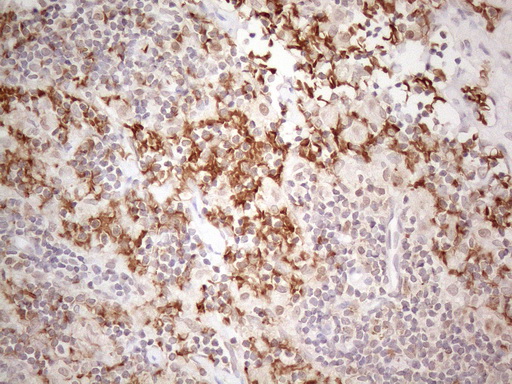 TNFSF5IP1 / CLAST3 Antibody - Immunohistochemical staining of paraffin-embedded Carcinoma of Human thyroid tissue using anti-PSMG2 mouse monoclonal antibody. (Heat-induced epitope retrieval by 1mM EDTA in 10mM Tris buffer. (pH8.5) at 120°C for 3 min. (1:150)