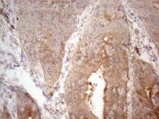 TNFSF5IP1 / CLAST3 Antibody - Immunohistochemical staining of paraffin-embedded Adenocarcinoma of Human colon tissue using anti-PSMG2 mouse monoclonal antibody. (Heat-induced epitope retrieval by 1mM EDTA in 10mM Tris buffer. (pH8.5) at 120°C for 3 min. (1:150)