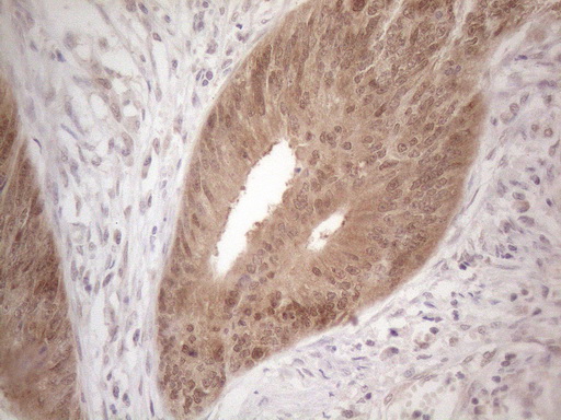 TNFSF5IP1 / CLAST3 Antibody - Immunohistochemical staining of paraffin-embedded Adenocarcinoma of Human colon tissue using anti-PSMG2 mouse monoclonal antibody. (Heat-induced epitope retrieval by 1mM EDTA in 10mM Tris buffer. (pH8.5) at 120°C for 3 min. (1:150)