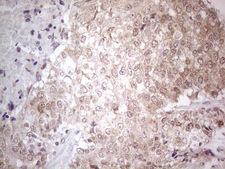 TNFSF5IP1 / CLAST3 Antibody - Immunohistochemical staining of paraffin-embedded Adenocarcinoma of Human endometrium tissue using anti-PSMG2 mouse monoclonal antibody. (Heat-induced epitope retrieval by 1mM EDTA in 10mM Tris buffer. (pH8.5) at 120°C for 3 min. (1:150)