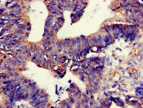 TNIK Antibody - Immunohistochemistry of paraffin-embedded human colon cancer at dilution of 1:100