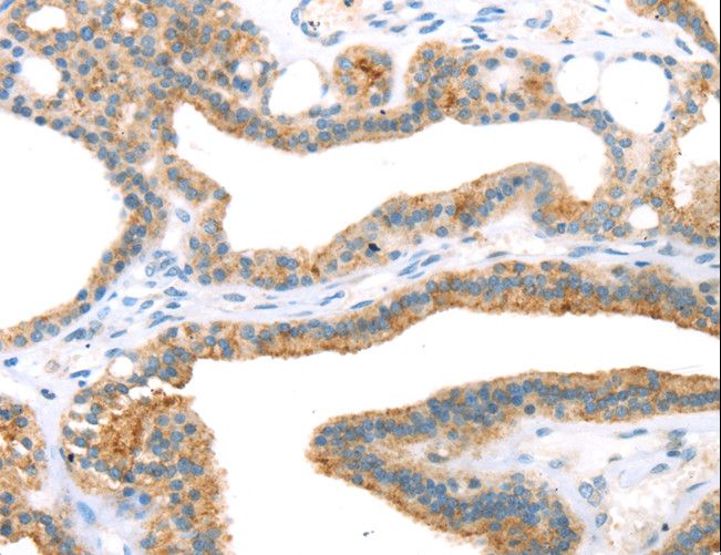 TNIP2 / ABIN-2 Antibody - Immunohistochemistry of paraffin-embedded Human thyroid cancer using TNIP2 Polyclonal Antibody at dilution of 1:35.