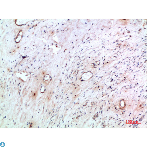 TNIP2 / ABIN-2 Antibody - Immunohistochemical analysis of paraffin-embedded human-cervical-cancer, antibody was diluted at 1:200.