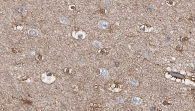 TNIP3 Antibody - 1:100 staining human brain carcinoma tissue by IHC-P. The sample was formaldehyde fixed and a heat mediated antigen retrieval step in citrate buffer was performed. The sample was then blocked and incubated with the antibody for 1.5 hours at 22°C. An HRP conjugated goat anti-rabbit antibody was used as the secondary.