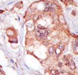 TNK1 Antibody - Formalin-fixed and paraffin-embedded human cancer tissue reacted with the primary antibody, which was peroxidase-conjugated to the secondary antibody, followed by AEC staining. This data demonstrates the use of this antibody for immunohistochemistry; clinical relevance has not been evaluated. BC = breast carcinoma; HC = hepatocarcinoma.
