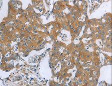TNK2 / ACK1 Antibody - Immunohistochemistry of paraffin-embedded Human breast cancer using TNK2 Polyclonal Antibody at dilution of 1:70.