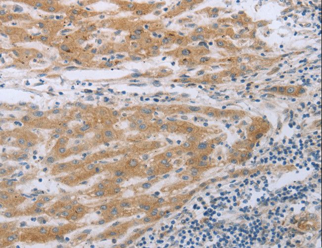 TNK2 / ACK1 Antibody - Immunohistochemistry of paraffin-embedded Human liver cancer using TNK2 Polyclonal Antibody at dilution of 1:70.