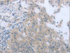 TNK2 / ACK1 Antibody - Immunohistochemistry of paraffin-embedded Human ovarian cancer using TNK2 Polyclonal Antibody at dilution of 1:70.