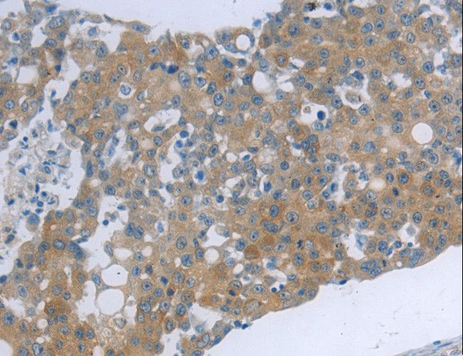 TNK2 / ACK1 Antibody - Immunohistochemistry of paraffin-embedded Human ovarian cancer using TNK2 Polyclonal Antibody at dilution of 1:70.