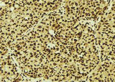 TNK2 / ACK1 Antibody - 1:100 staining human breast carcinoma tissue by IHC-P. The sample was formaldehyde fixed and a heat mediated antigen retrieval step in citrate buffer was performed. The sample was then blocked and incubated with the antibody for 1.5 hours at 22°C. An HRP conjugated goat anti-rabbit antibody was used as the secondary.