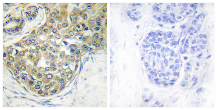 TNK2 / ACK1 Antibody - Immunohistochemistry analysis of paraffin-embedded human breast carcinoma, using ACK1 (Phospho-Tyr284) Antibody. The picture on the right is blocked with the phospho peptide.