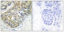 TNK2 / ACK1 Antibody - P-peptide - + Immunohistochemistry analysis of paraffin-embedded human breast carcinoma tissue using ACK1 (Phospho-Tyr284) antibody.
