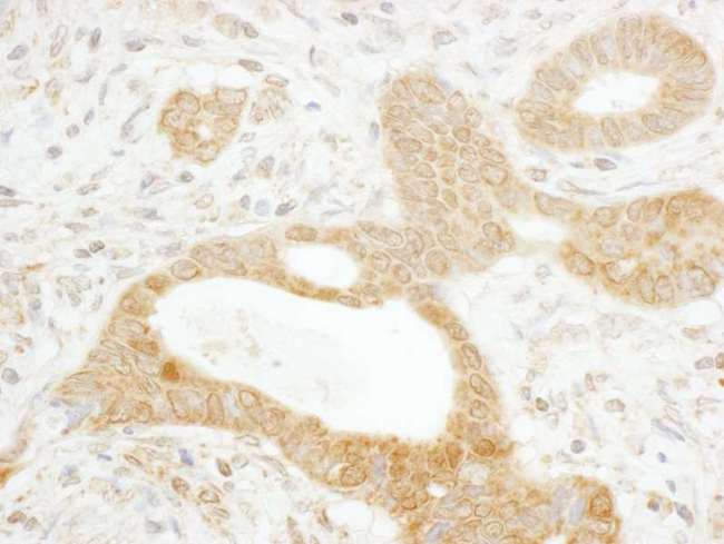 TNKS / Tankyrase Antibody - Detection of Human Tankyrase 1 by Immunohistochemistry. Sample: FFPE section of human stomach carcinoma. Antibody: Affinity purified rabbit anti-Tankyrase 1 used at a dilution of 1:1000 (1 ug/ml). Detection: DAB.