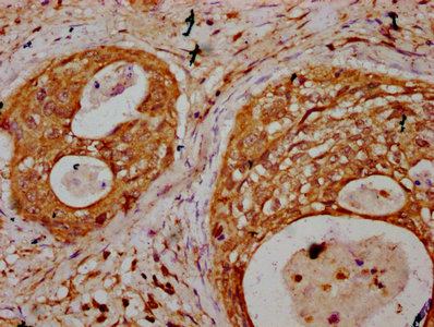 TNN / Tenascin N Antibody - Immunohistochemistry Dilution at 1:400 and staining in paraffin-embedded human cervical cancer performed on a Leica BondTM system. After dewaxing and hydration, antigen retrieval was mediated by high pressure in a citrate buffer (pH 6.0). Section was blocked with 10% normal Goat serum 30min at RT. Then primary antibody (1% BSA) was incubated at 4°C overnight. The primary is detected by a biotinylated Secondary antibody and visualized using an HRP conjugated SP system.