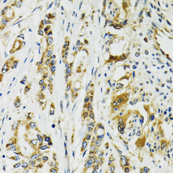 TNNC1 / Cardiac Troponin C Antibody - Immunohistochemistry of paraffin-embedded human colon carcinoma tissue.