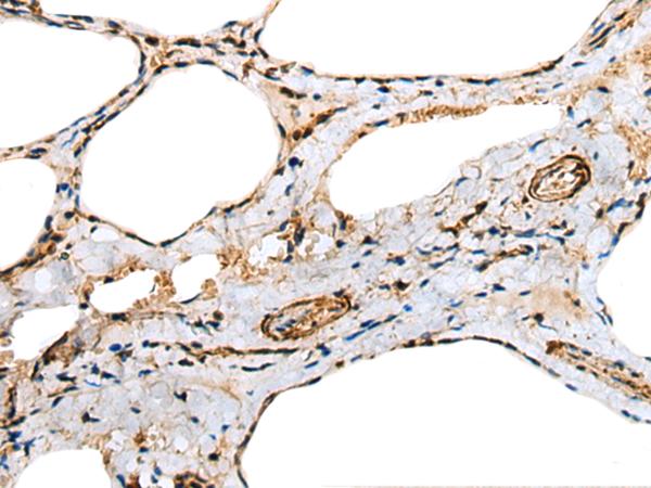 TNNC1 / Cardiac Troponin C Antibody - Immunohistochemistry of paraffin-embedded Human thyroid cancer tissue  using TNNC1 Polyclonal Antibody at dilution of 1:25(×200)
