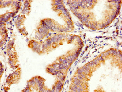 TNNI3 / Cardiac Troponin I Antibody - IHC image of SPA17 Antibody diluted at 1:200 and staining in paraffin-embedded human endometrial cancer performed on a Leica BondTM system. After dewaxing and hydration, antigen retrieval was mediated by high pressure in a citrate buffer (pH 6.0). Section was blocked with 10% normal goat serum 30min at RT. Then primary antibody (1% BSA) was incubated at 4°C overnight. The primary is detected by a biotinylated secondary antibody and visualized using an HRP conjugated SP system.