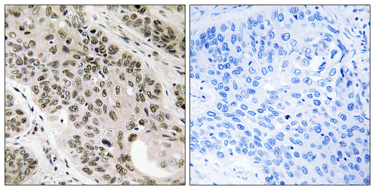 TNNI3K / CARK Antibody - Immunohistochemistry analysis of paraffin-embedded human lung carcinoma tissue, using TNNI3K Antibody. The picture on the right is blocked with the synthesized peptide.